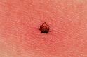 Ixodes_ricinus_D5036_Z_89_Les Gris_Frankrijk